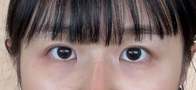 Before — Returning Plastic Surgery