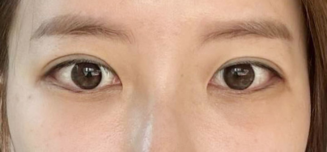 After — Returning Plastic Surgery