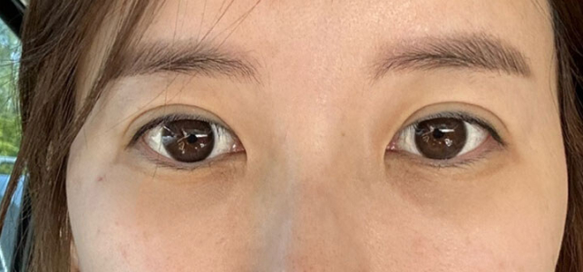 Before — Returning Plastic Surgery
