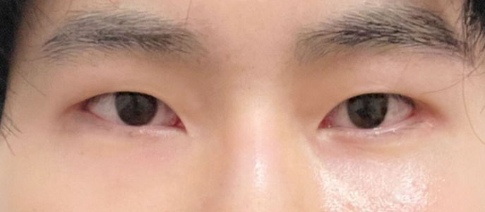 After — Returning Plastic Surgery