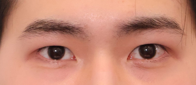 Before — Returning Plastic Surgery