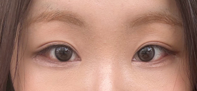 After — Returning Plastic Surgery