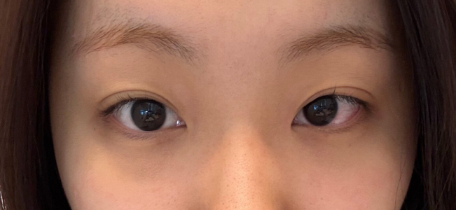 Before — Returning Plastic Surgery