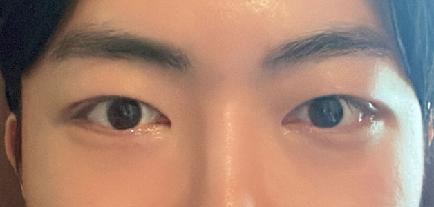 After — Returning Plastic Surgery
