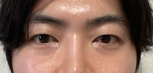 Before — Returning Plastic Surgery