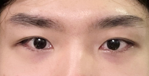 After — Returning Plastic Surgery