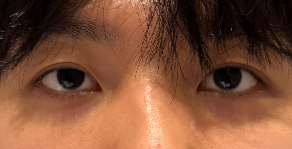 Before — Returning Plastic Surgery