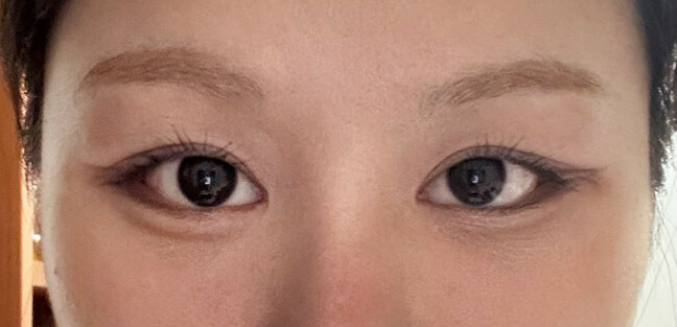 After — Returning Plastic Surgery