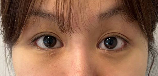 Before — Returning Plastic Surgery