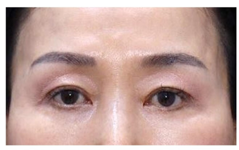 After — Returning Plastic Surgery