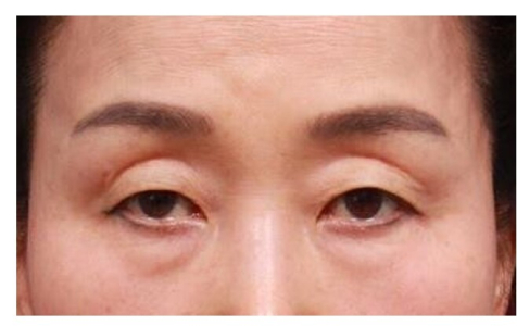 Before — Returning Plastic Surgery
