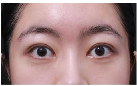 After — Returning Plastic Surgery