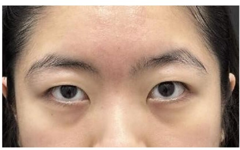 Before — Returning Plastic Surgery
