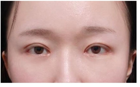 After — Returning Plastic Surgery