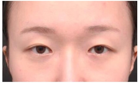 Before — Returning Plastic Surgery