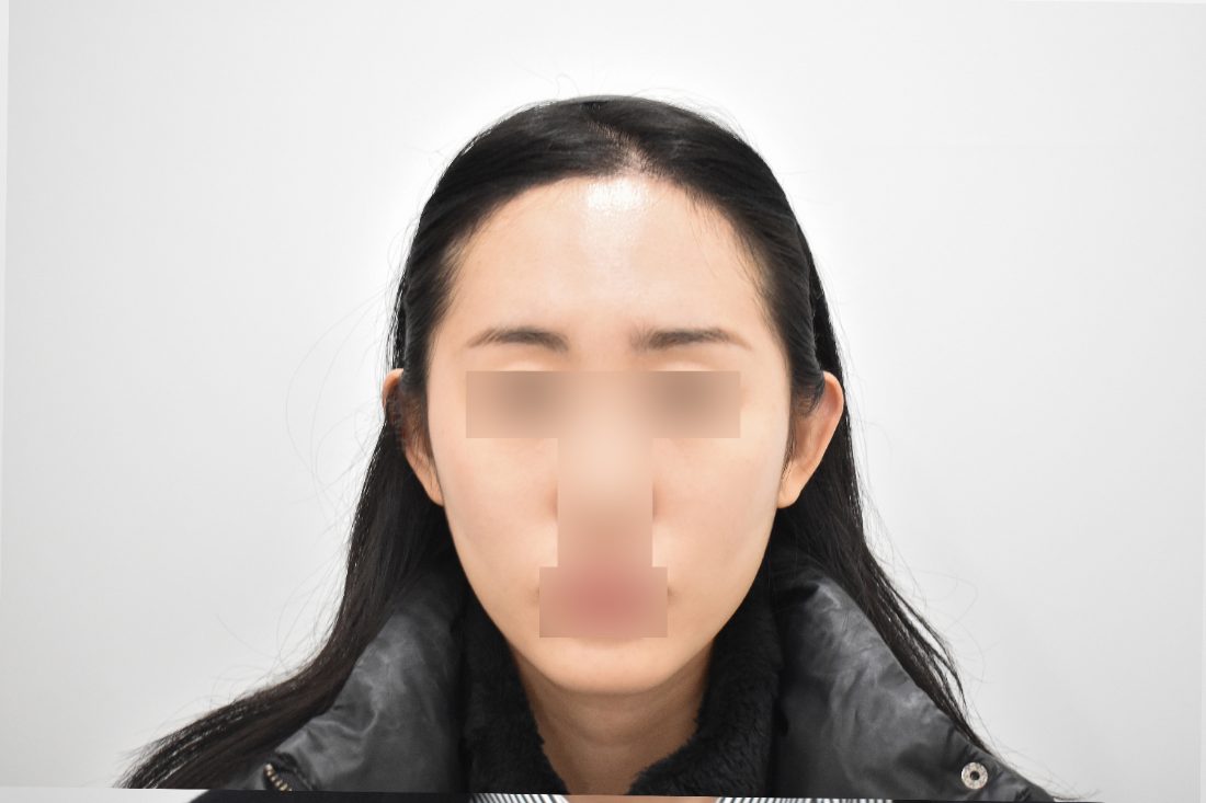 顧客1額頭填充假體術後——正面 - MISOODA