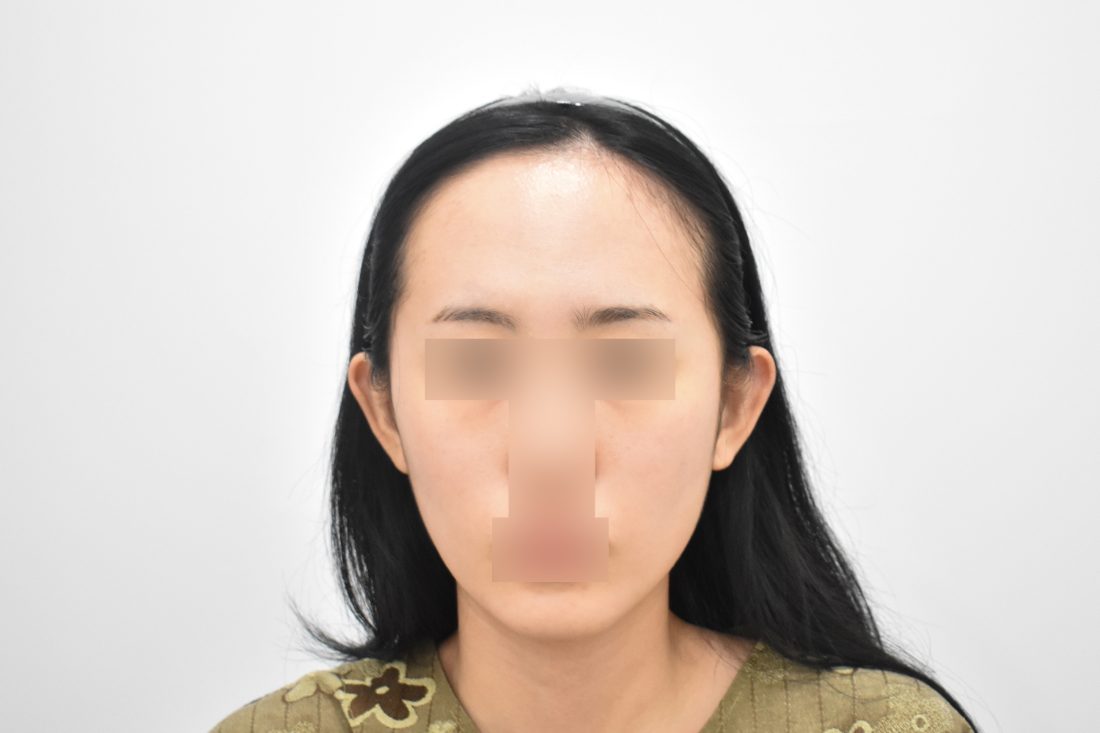 顧客1額頭填充假體術前——正面 - MISOODA