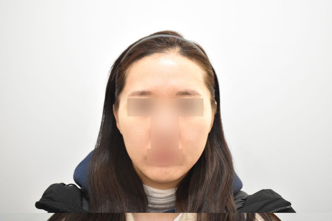 顧客2額頭填充假體術後——正面 - MISOODA