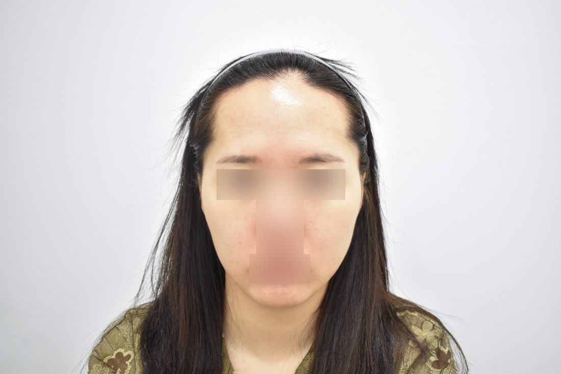 顧客2額頭填充假體術前——正面 - MISOODA